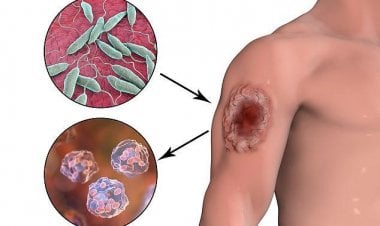 بالصور... طفيليات آكلة للحوم البشر في أمريكا